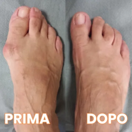 Aiuta con l'alluce valgo